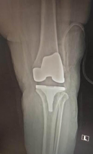 Pre and post-op x-ray of a patient-3